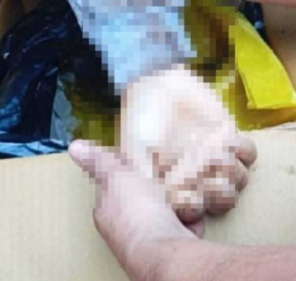 Maquina industrial tritura brazo  de un obrero en Hernandarias
